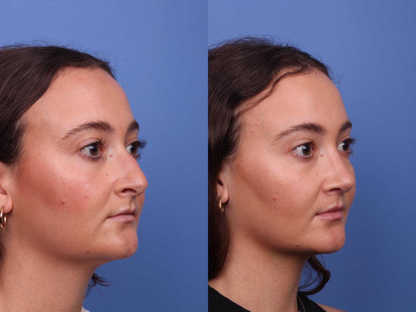Before & After Rhinoplasty Case 510 Right Oblique View in Scottsdale, AZ