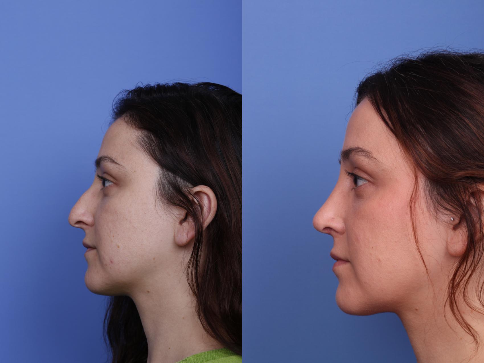 Before & After Rhinoplasty Case 512 Left Side View in Scottsdale, AZ