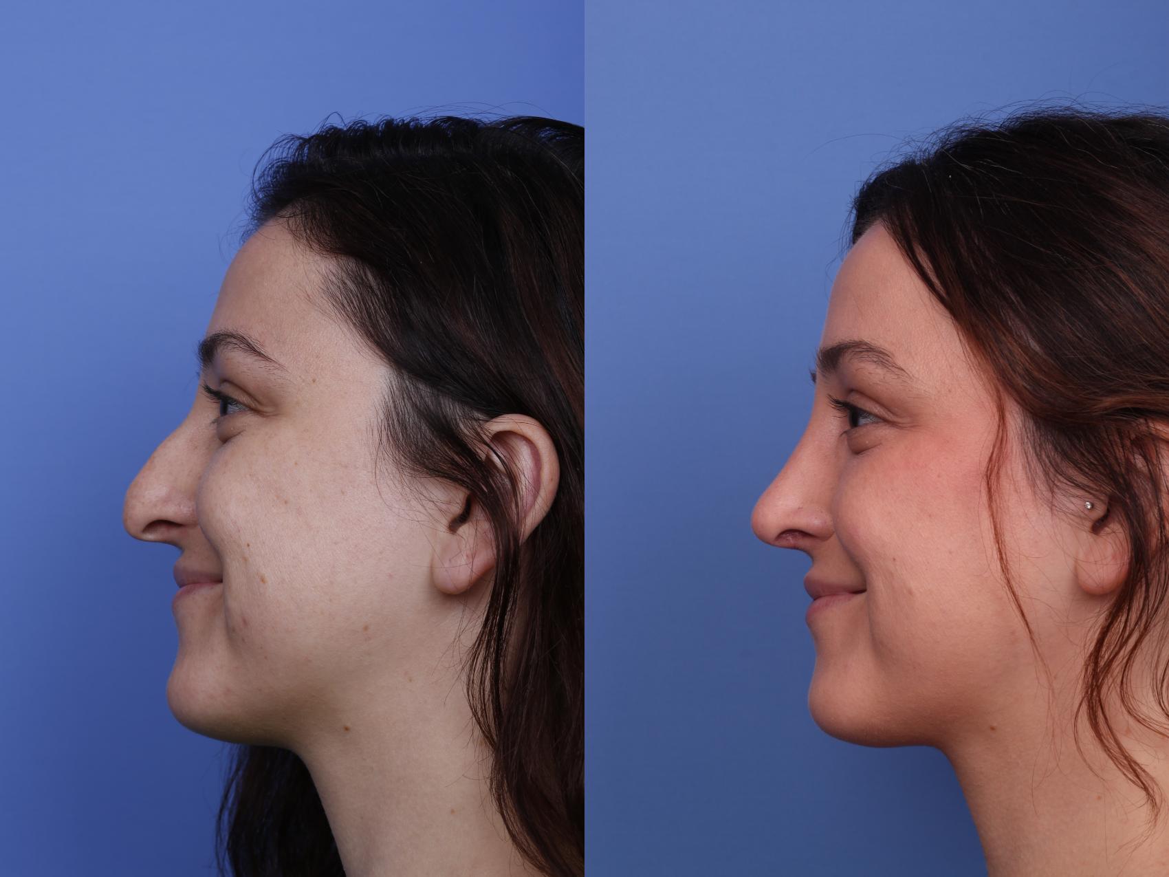 Before & After Rhinoplasty Case 512 Left Smile View in Scottsdale, AZ
