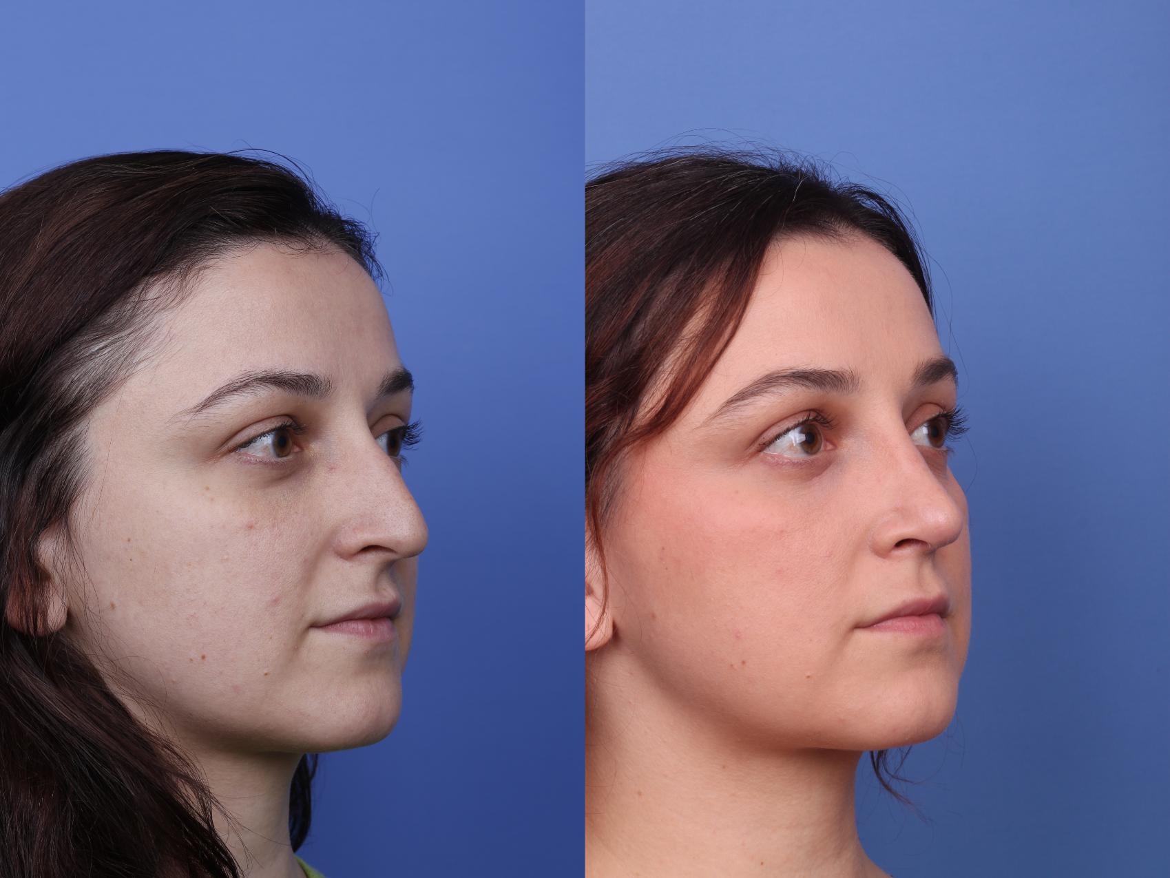 Before & After Rhinoplasty Case 512 Right Oblique View in Scottsdale, AZ