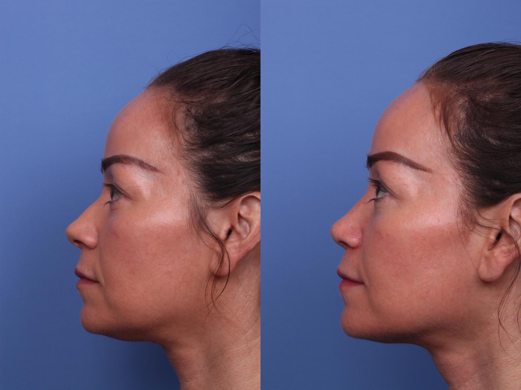 Before & After Rhinoplasty Case 513 Left Side View in Scottsdale, AZ