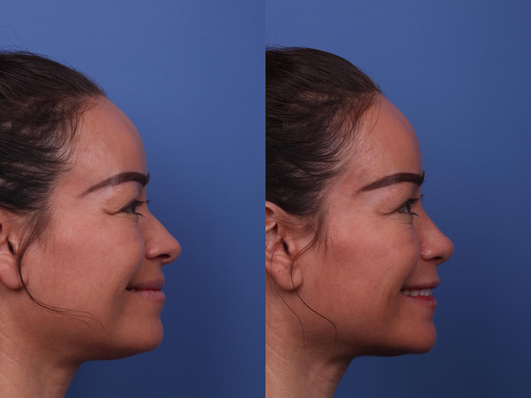 Before & After Rhinoplasty Case 513 Right Smile View in Scottsdale, AZ