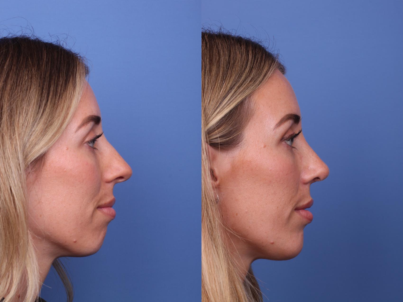 Before & After Chin Implant Case 514 Right Side View in Scottsdale, AZ