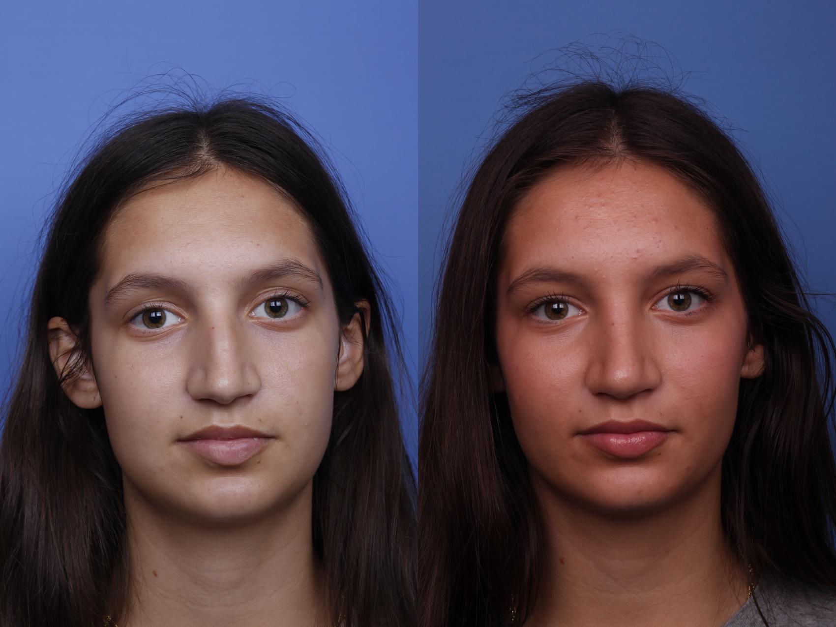 Before & After Rhinoplasty Case 516 Front View in Scottsdale, AZ