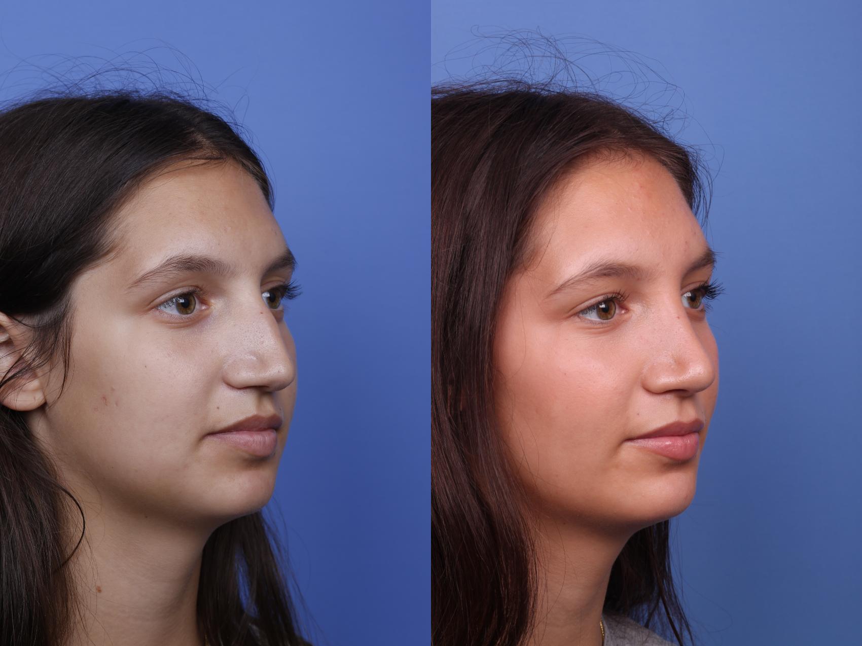 Before & After Rhinoplasty Case 516 Right Oblique View in Scottsdale, AZ