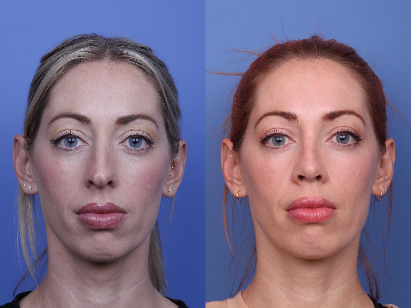 Before & After Rhinoplasty Case 518 Front View in Scottsdale, AZ