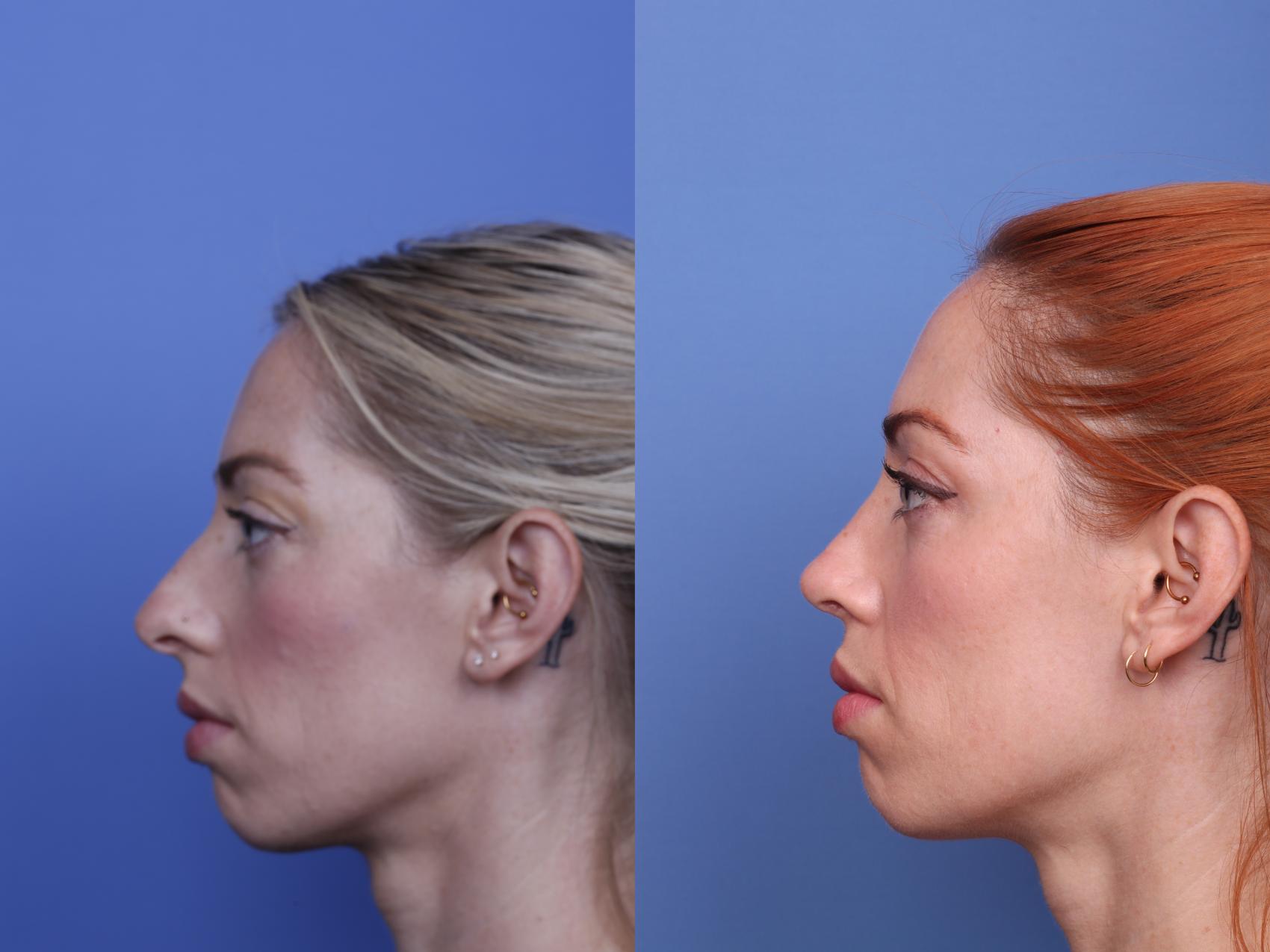 Before & After Rhinoplasty Case 518 Left Side View in Scottsdale, AZ
