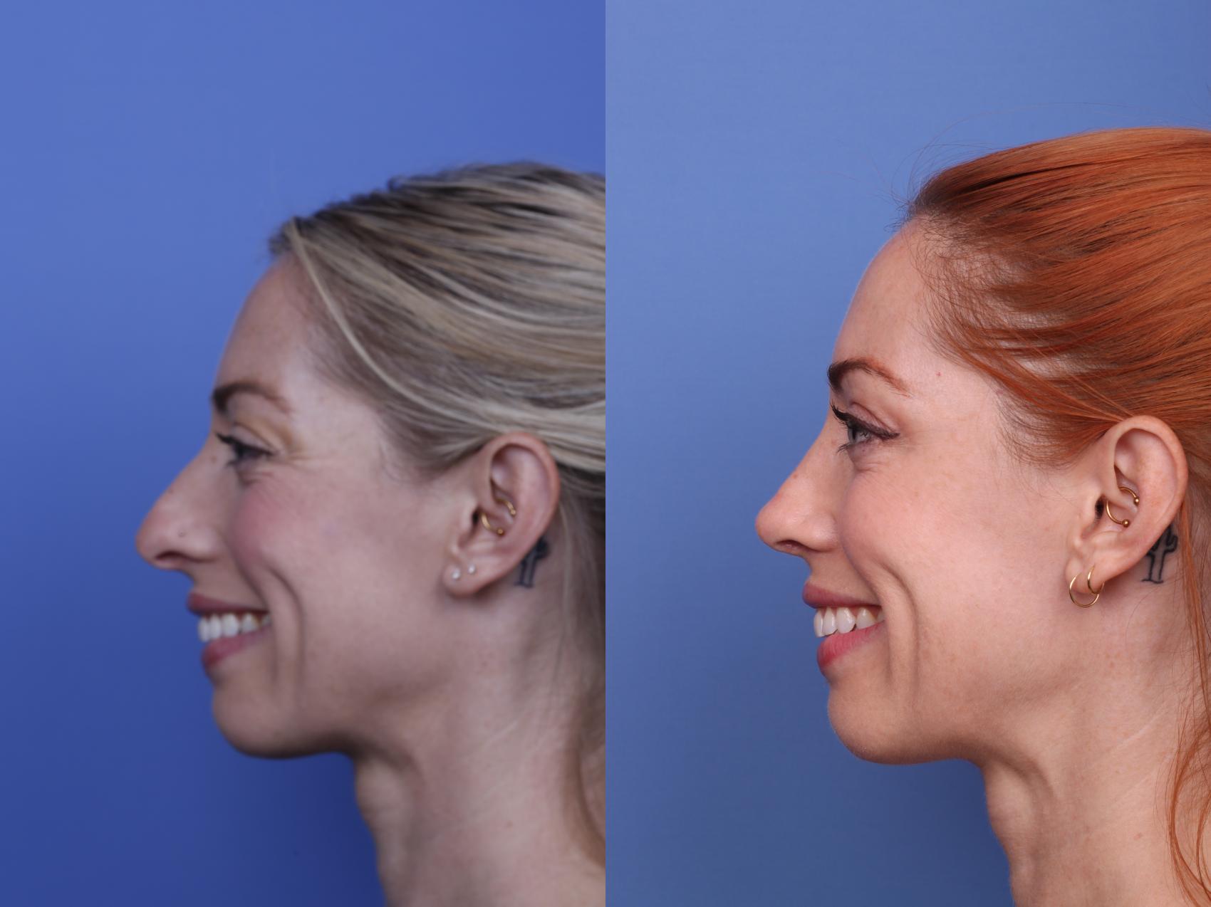 Before & After Rhinoplasty Case 518 Left Smile View in Scottsdale, AZ