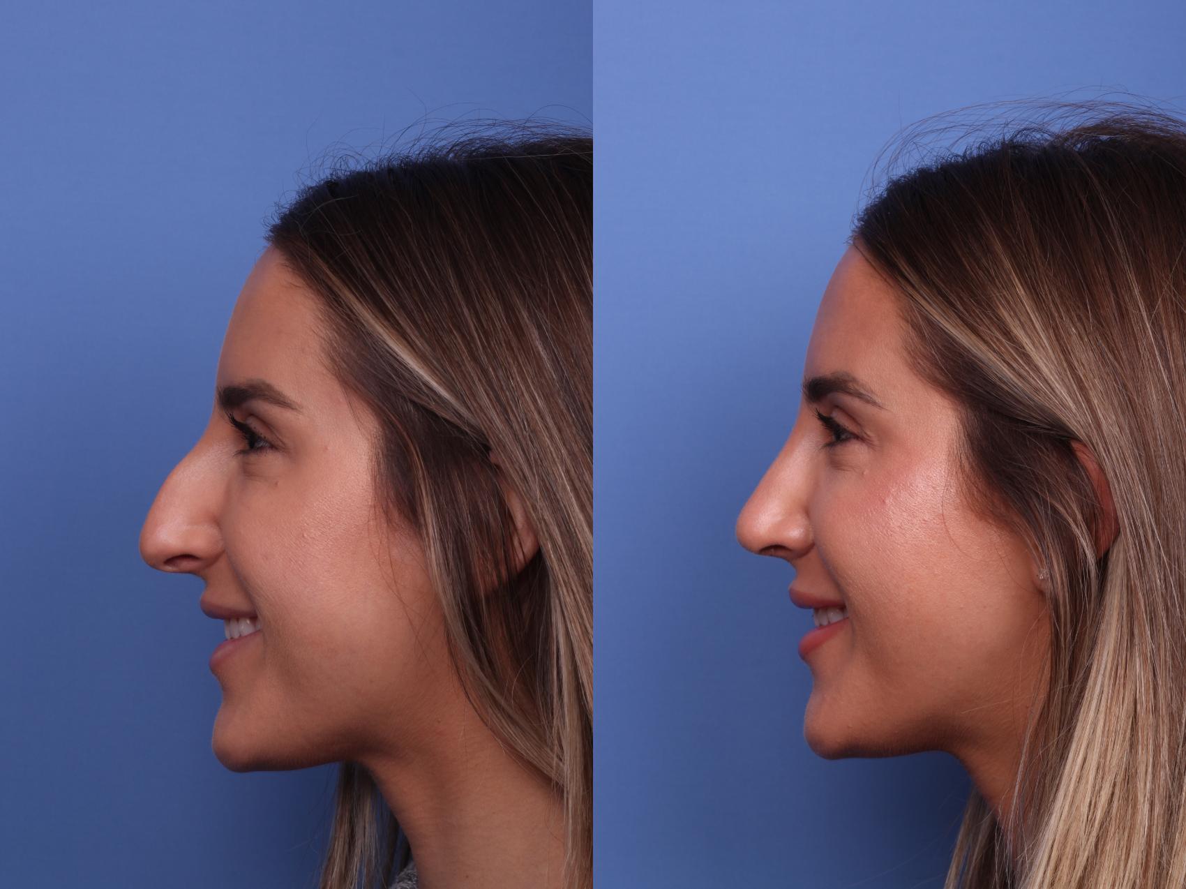 Before & After Rhinoplasty Case 519 Left Smile View in Scottsdale, AZ