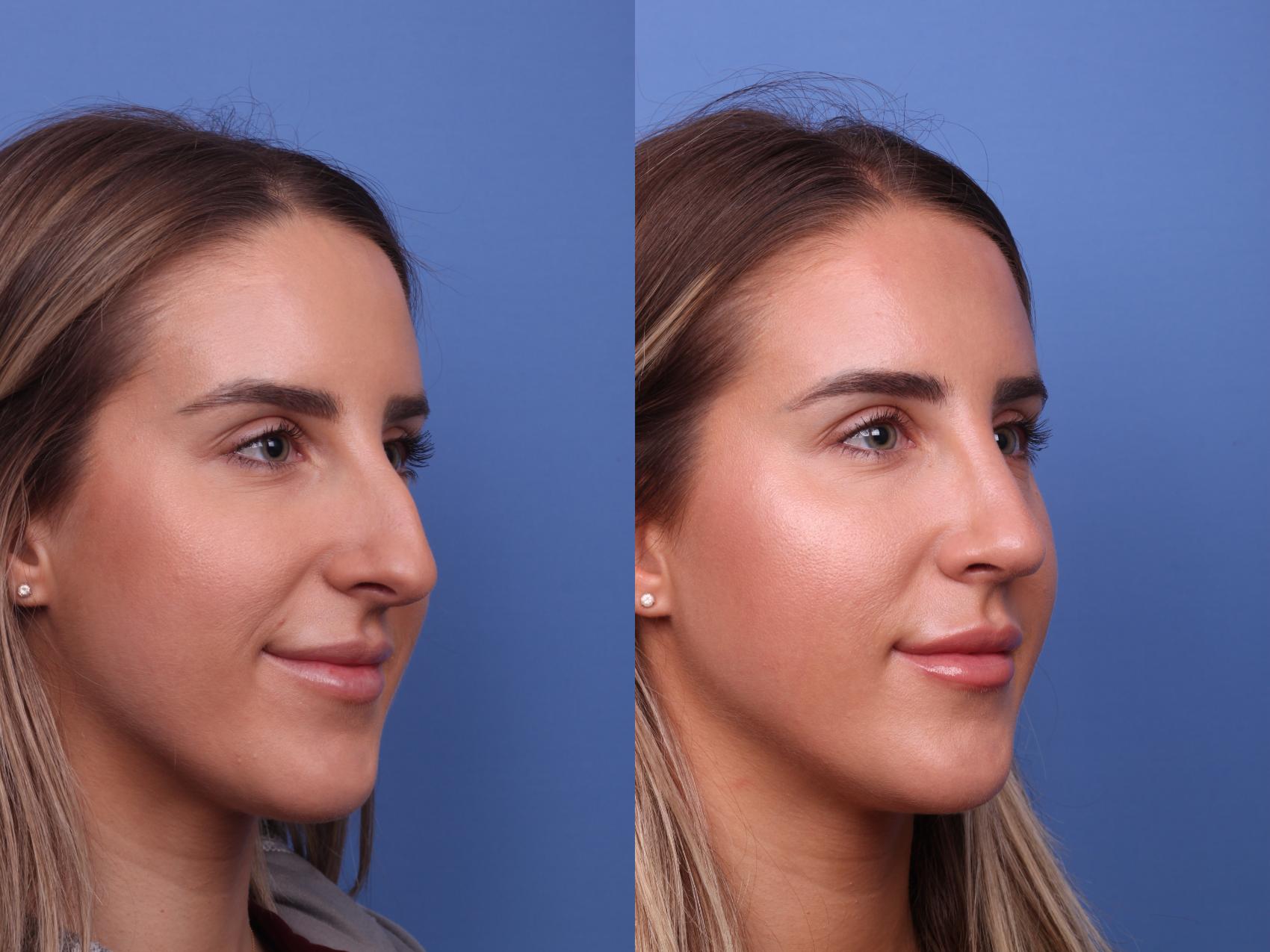 Before & After Rhinoplasty Case 519 Right Oblique View in Scottsdale, AZ