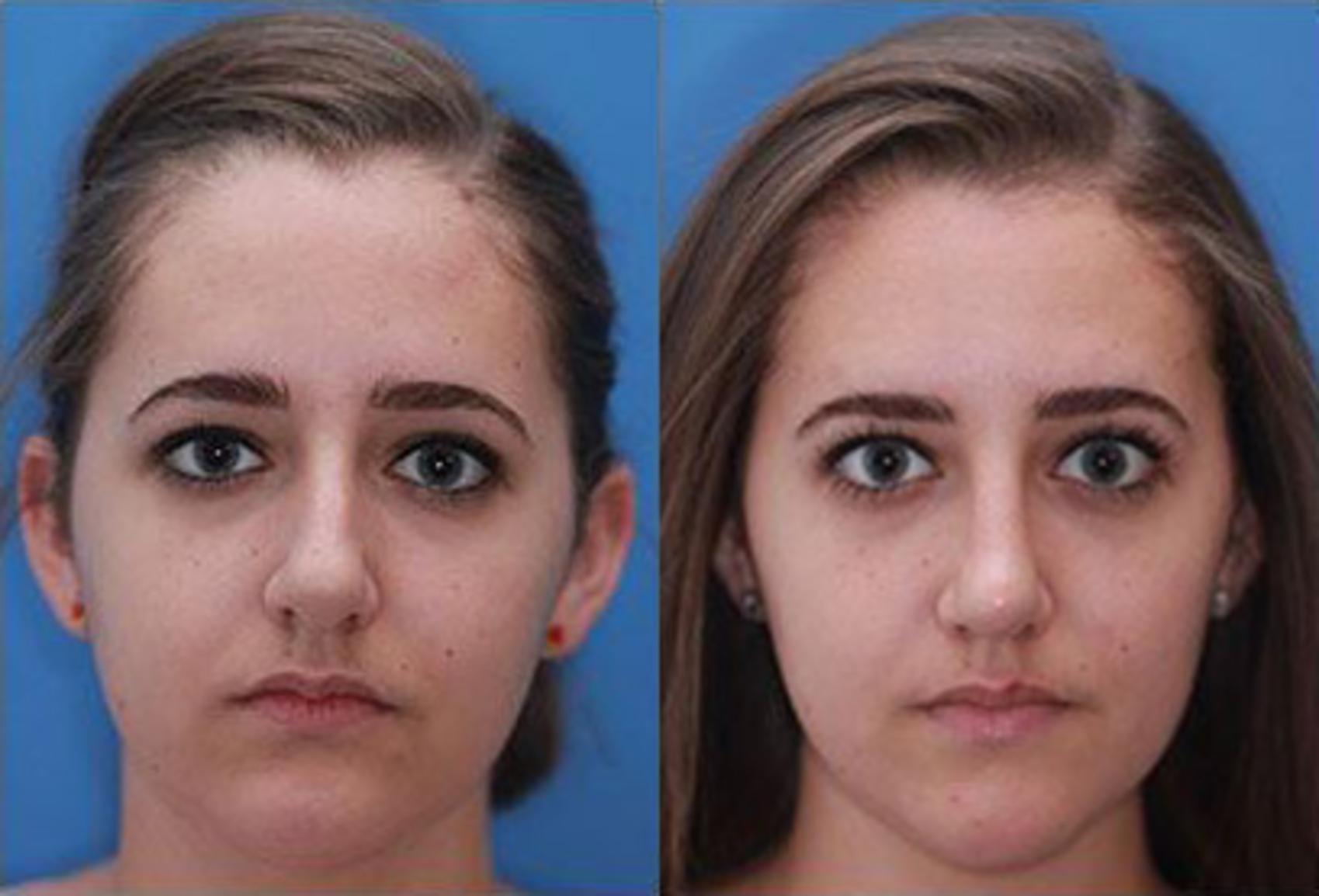 Before & After Rhinoplasty Case 52 View #2 View in Scottsdale, AZ