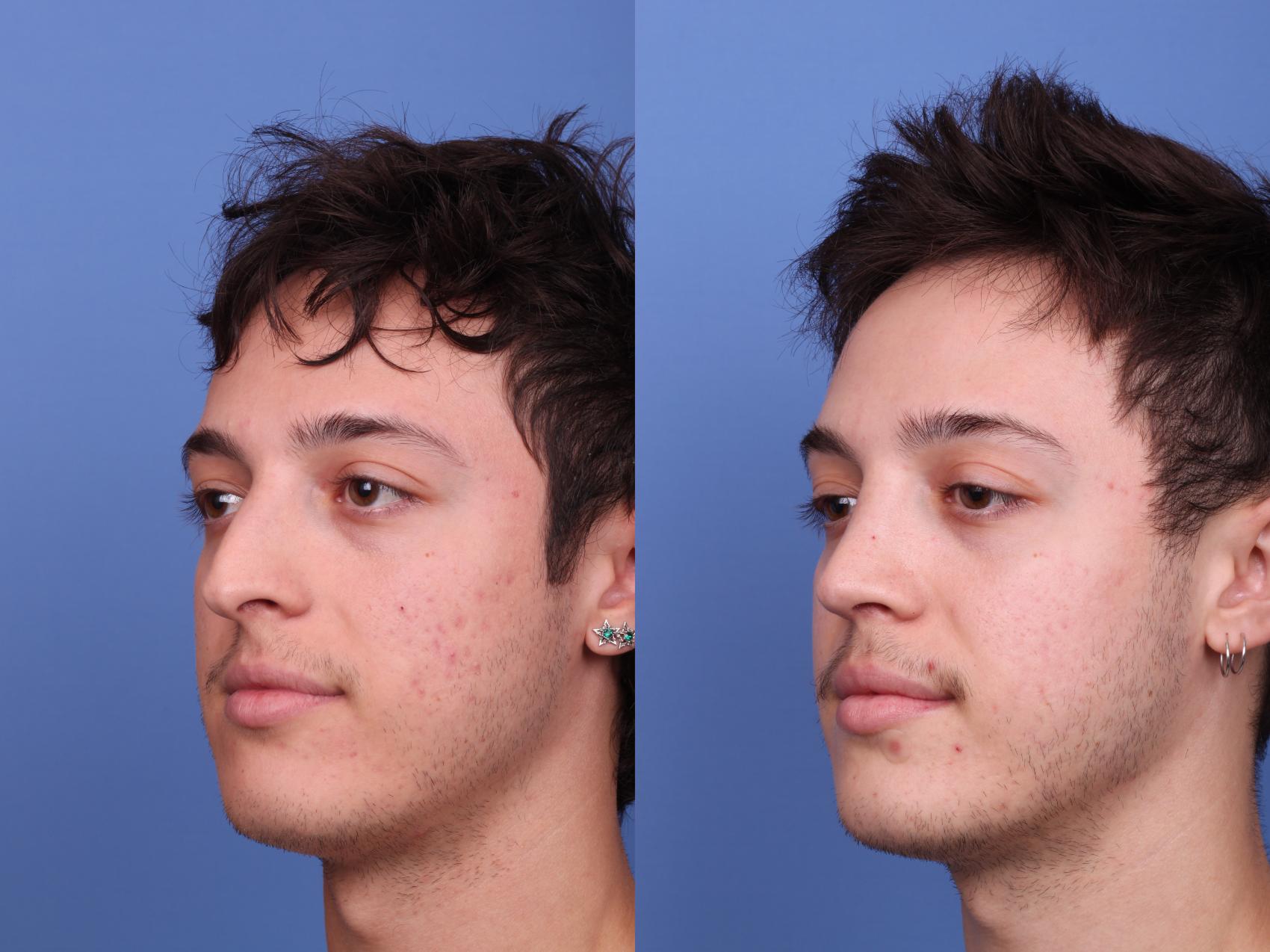 Before & After Rhinoplasty Case 523 Left Oblique View in Scottsdale, AZ