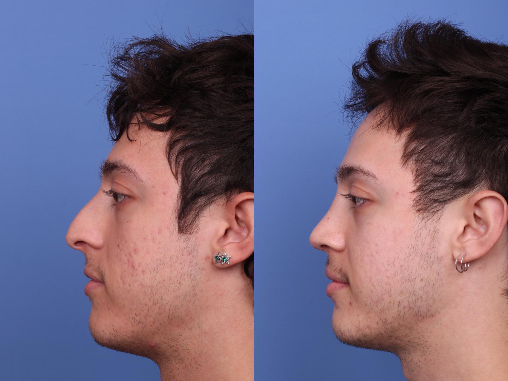 Before & After Rhinoplasty Case 523 Left Side View in Scottsdale, AZ