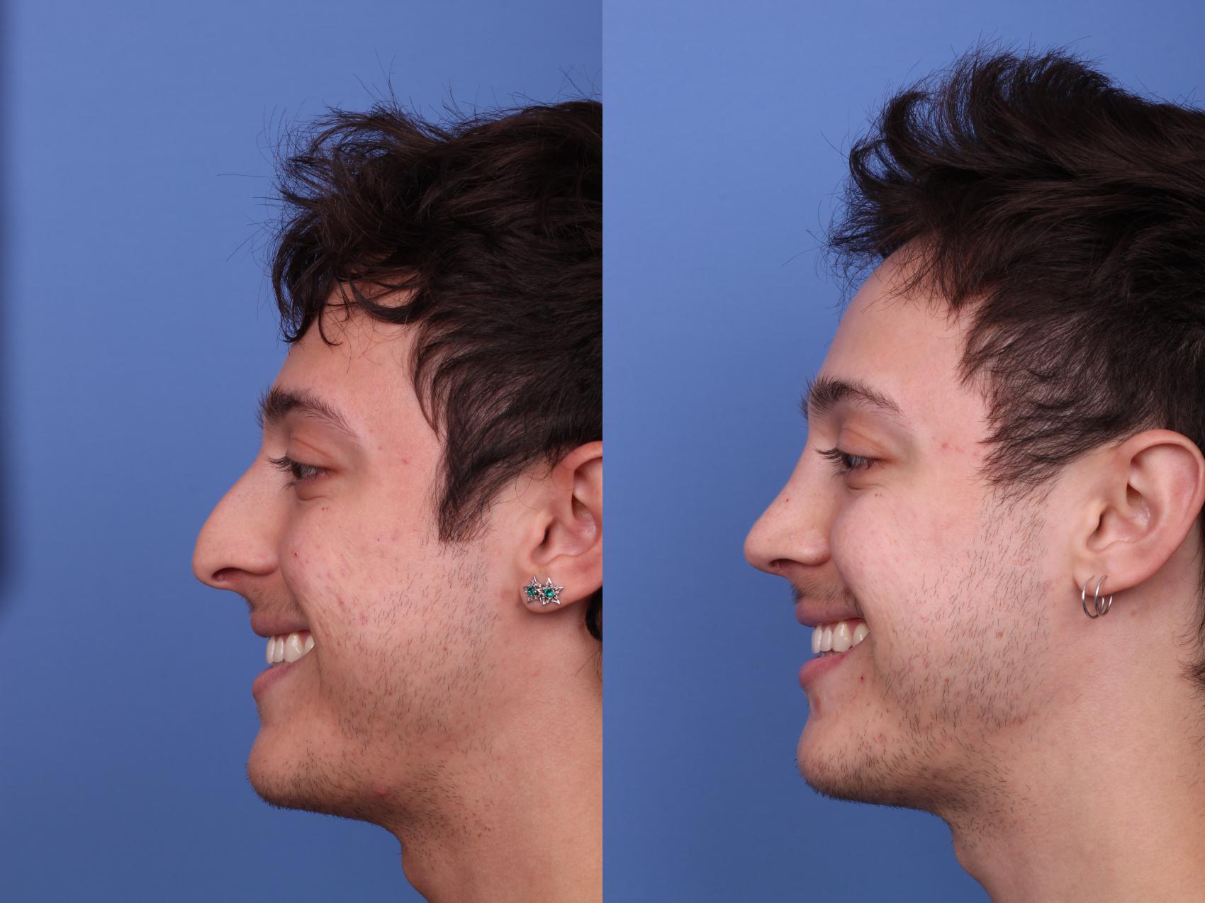 Before & After Rhinoplasty Case 523 Left Smile View in Scottsdale, AZ