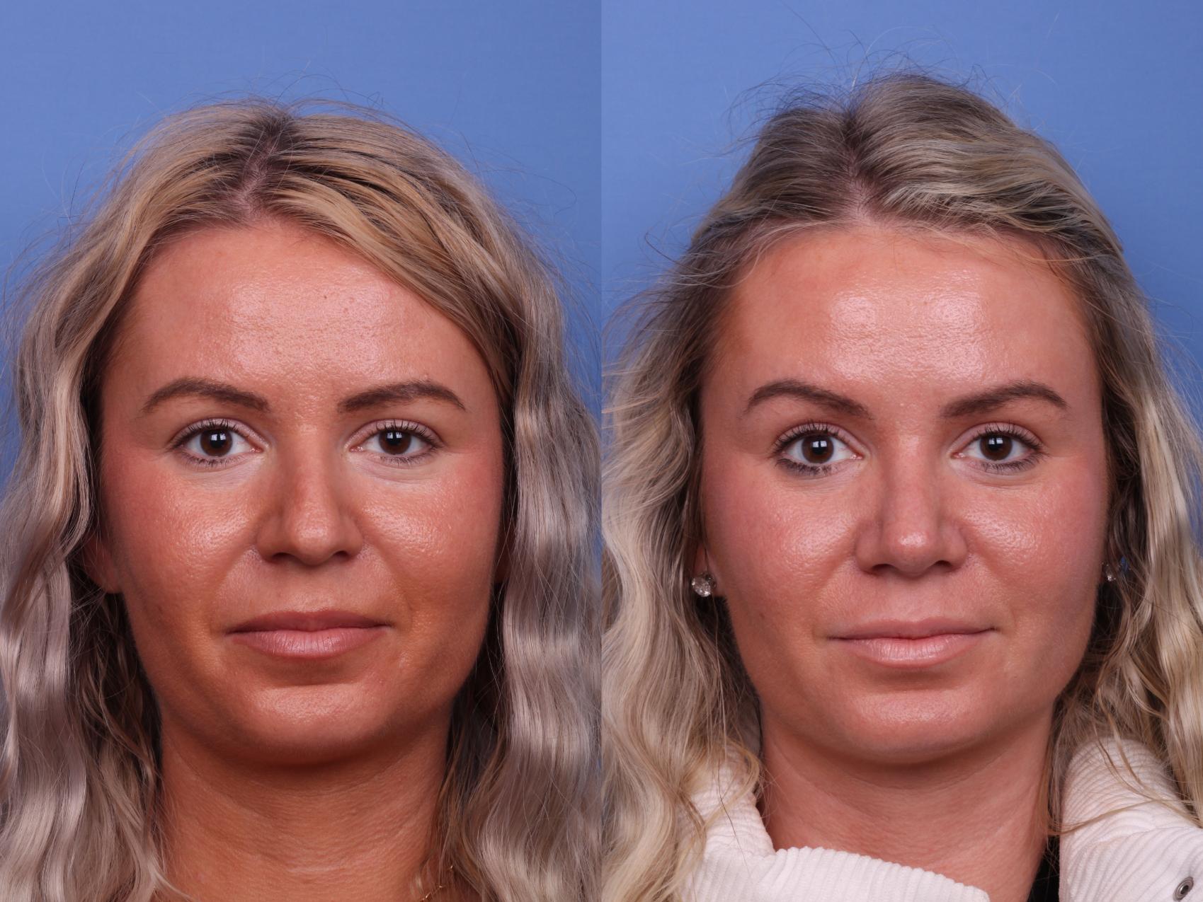 Before & After Rhinoplasty Case 524 Front View in Scottsdale, AZ