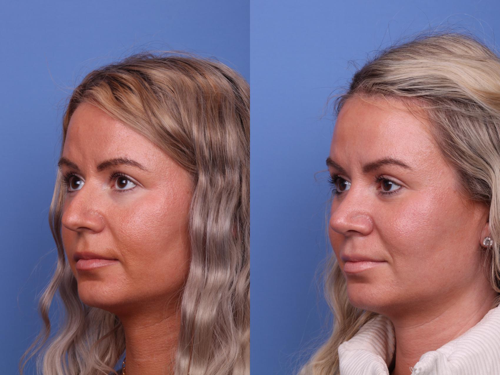 Before & After Rhinoplasty Case 524 Left Oblique View in Scottsdale, AZ