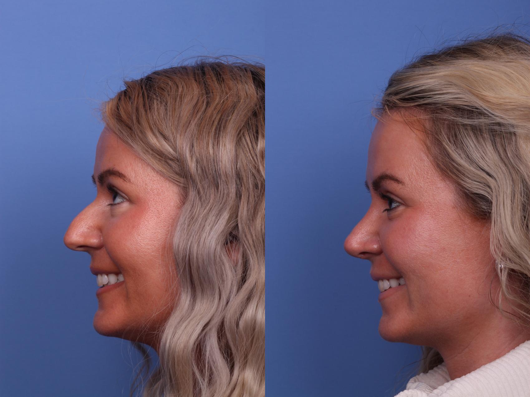 Before & After Rhinoplasty Case 524 Left Smile View in Scottsdale, AZ