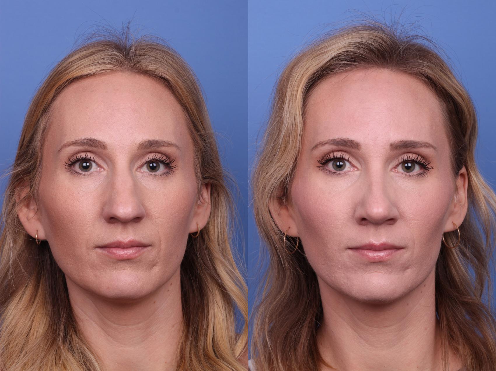 Before & After Rhinoplasty Case 525 Front View in Scottsdale, AZ