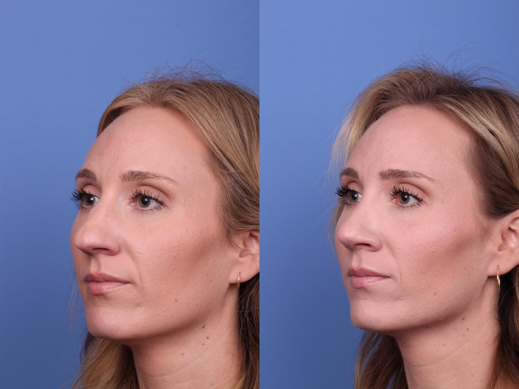 Before & After Rhinoplasty Case 525 Left Oblique View in Scottsdale, AZ
