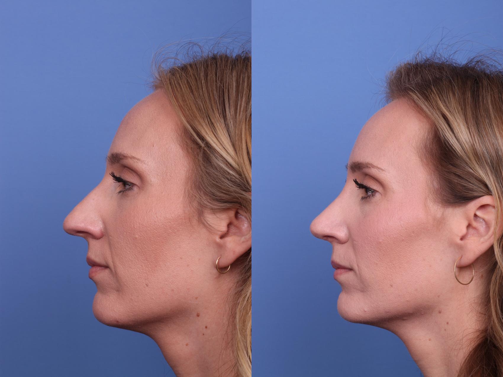 Before & After Rhinoplasty Case 525 Left Side View in Scottsdale, AZ