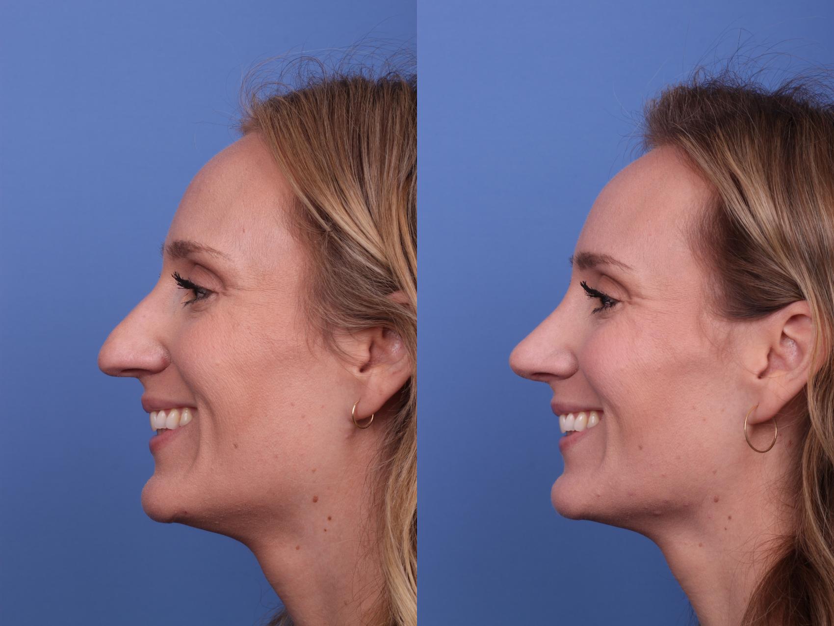 Before & After Rhinoplasty Case 525 Left Smile View in Scottsdale, AZ