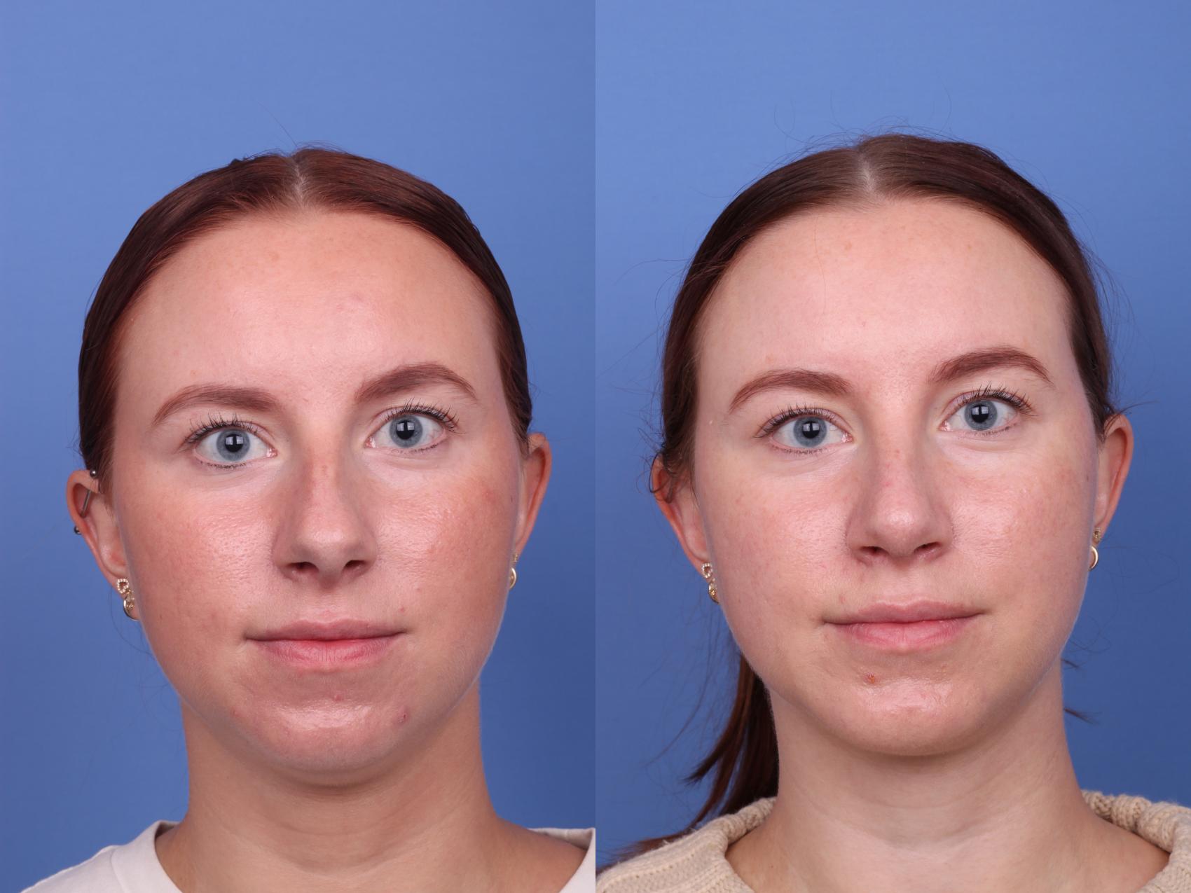 Before & After Rhinoplasty Case 527 Front View in Scottsdale, AZ