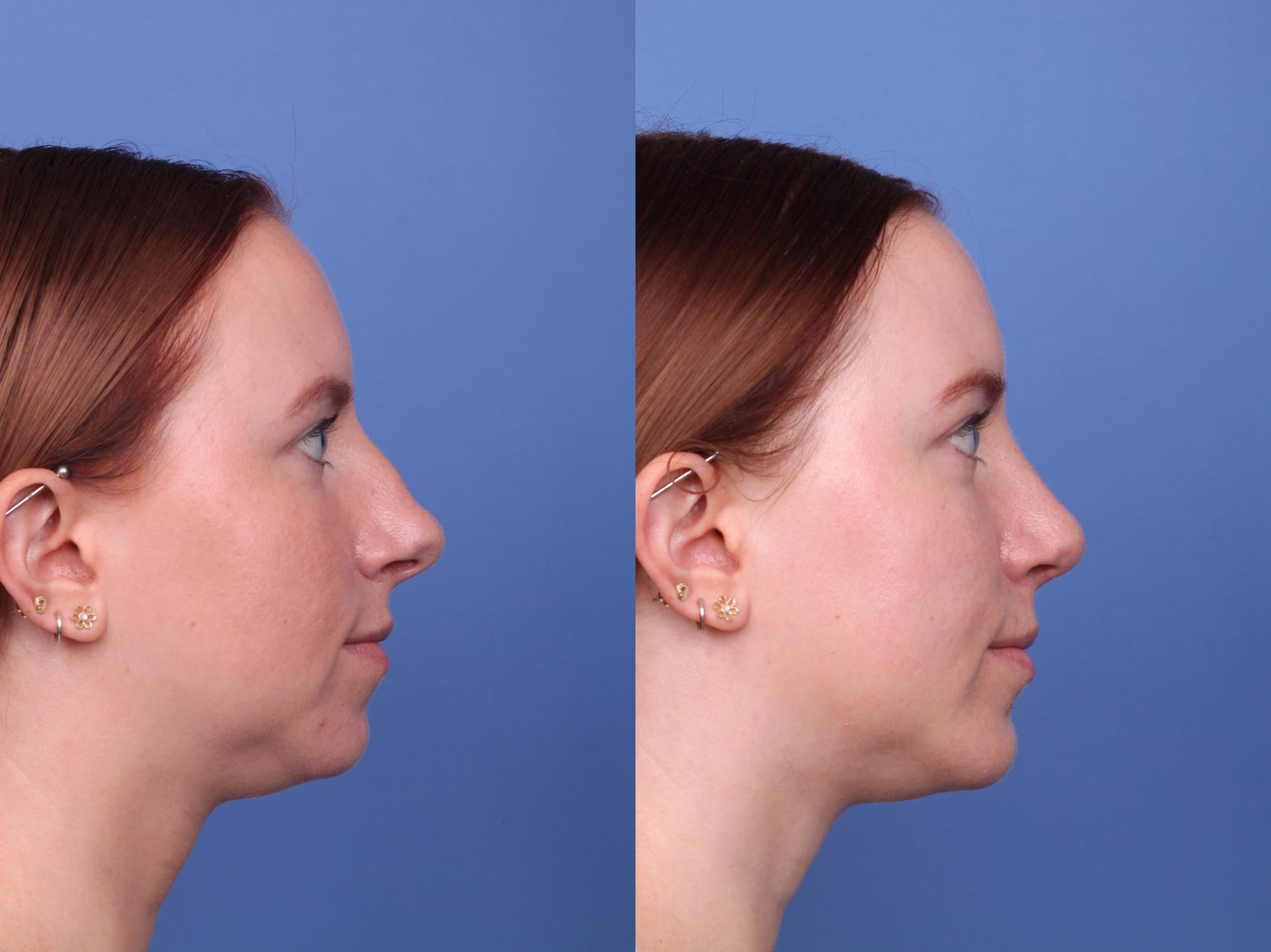 Before & After Rhinoplasty Case 527 Right Side View in Scottsdale, AZ