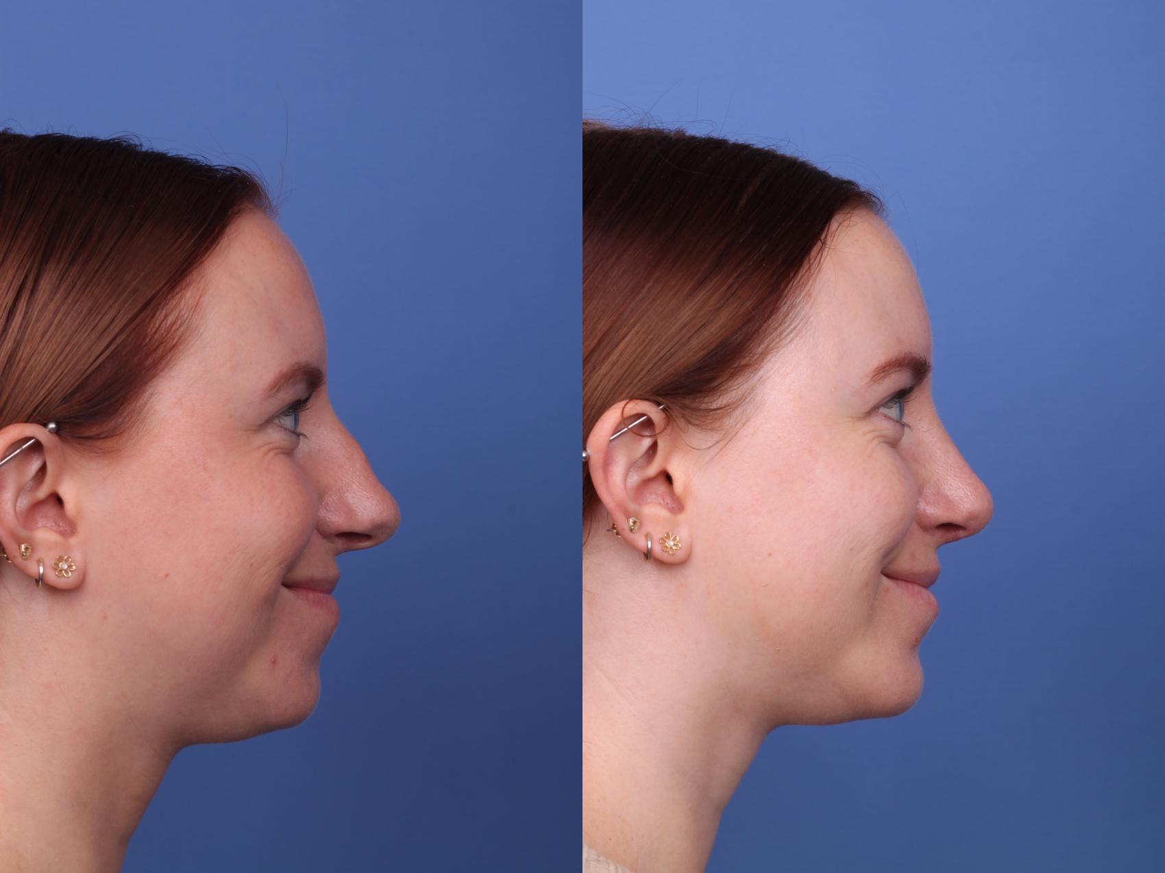 Before & After Rhinoplasty Case 527 Right Smile View in Scottsdale, AZ