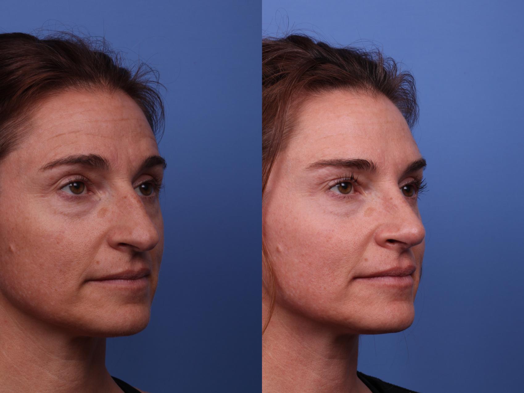Before & After Rhinoplasty Case 528 Right Oblique View in Scottsdale, AZ
