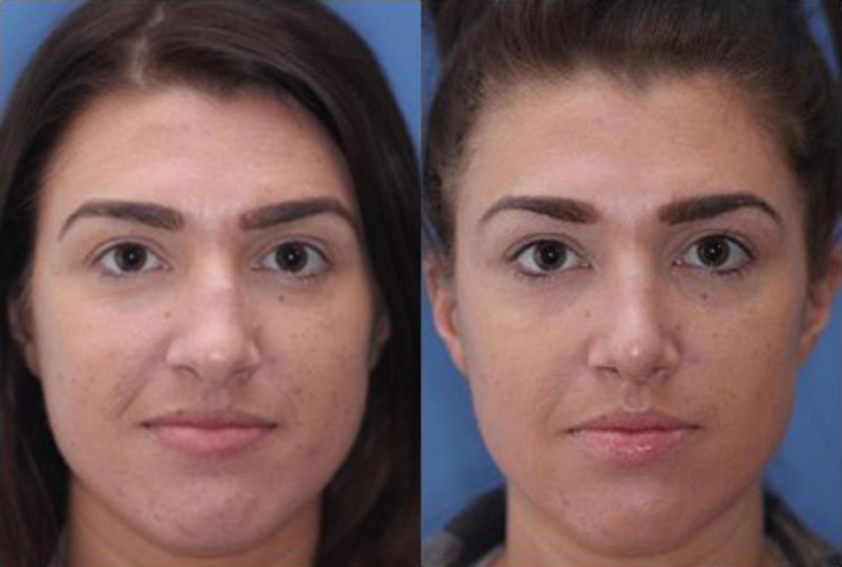 Before & After Rhinoplasty Case 53 View #2 View in Scottsdale, AZ