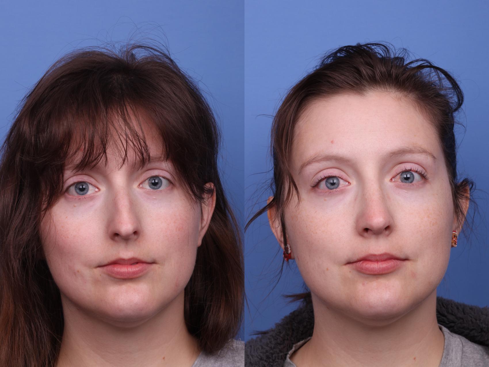 Before & After Rhinoplasty Case 530 Front View in Scottsdale, AZ
