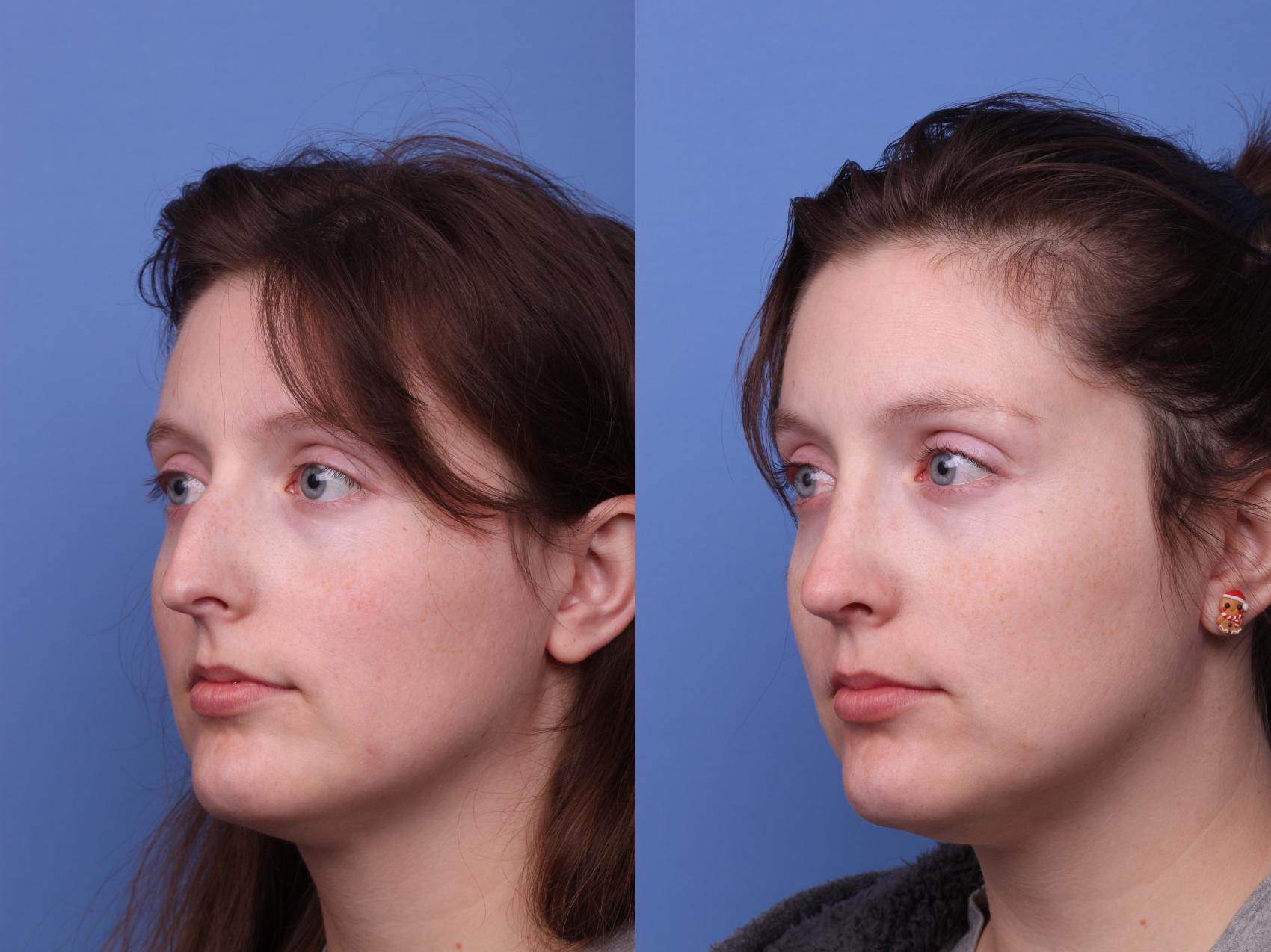 Before & After Rhinoplasty Case 530 Left Oblique View in Scottsdale, AZ