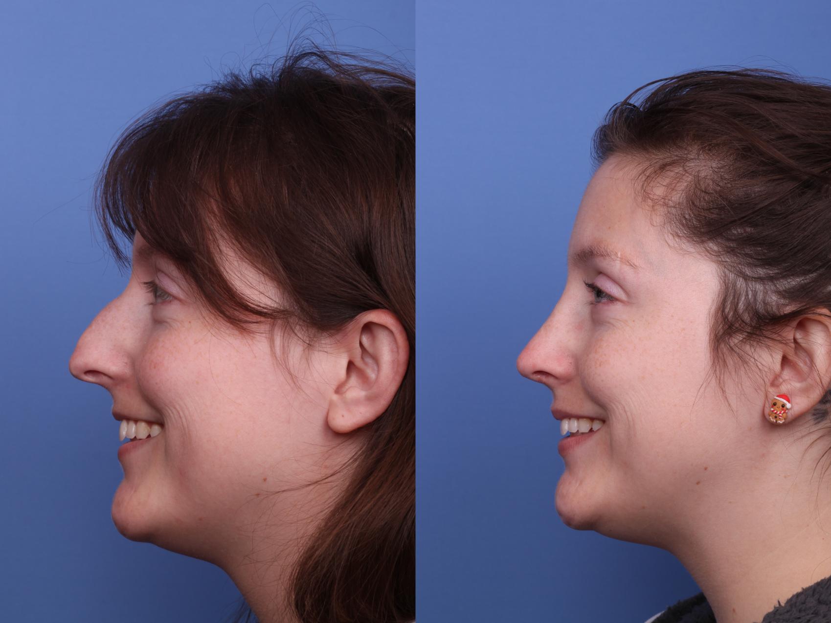 Before & After Rhinoplasty Case 530 Left Smile View in Scottsdale, AZ