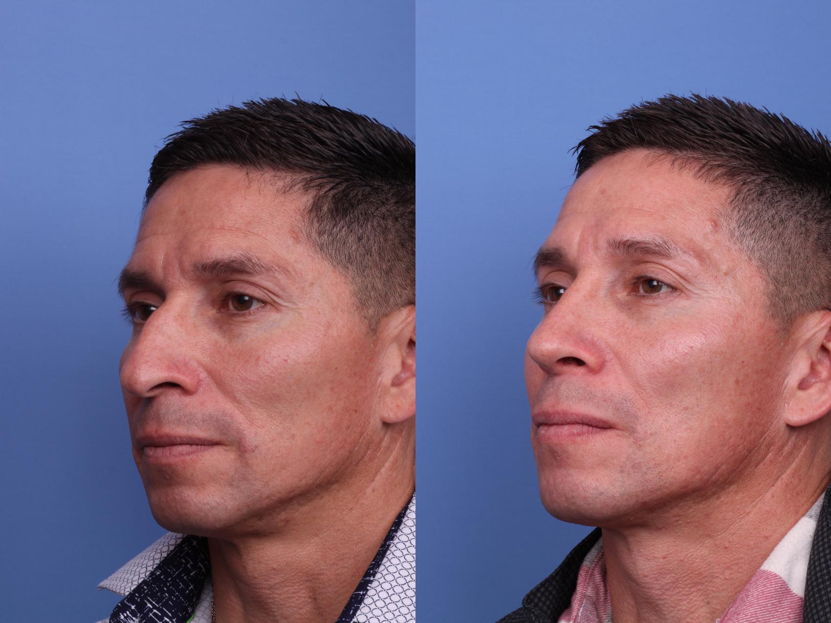 Before & After Ethnic Rhinoplasty Case 531 Left Oblique View in Scottsdale, AZ