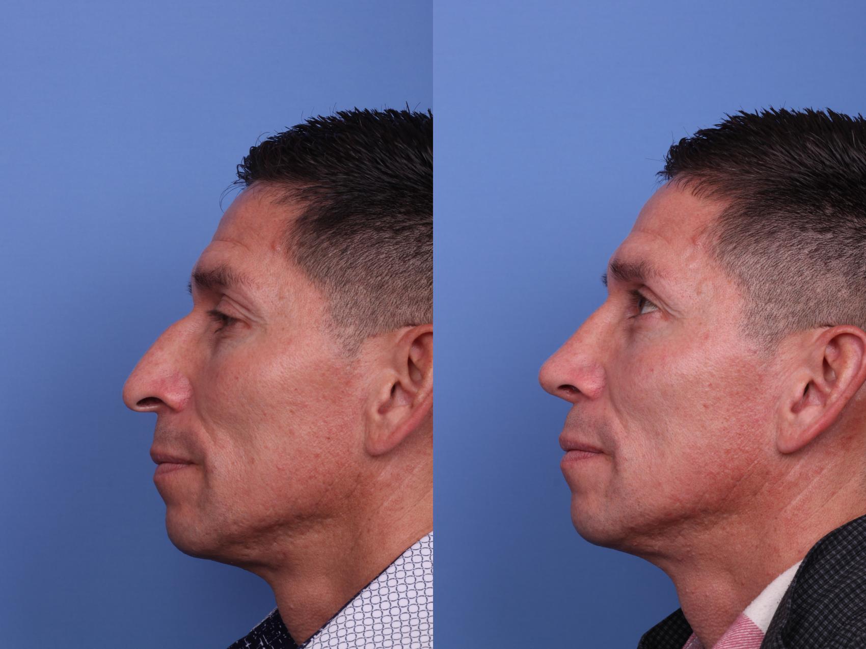 Before & After Ethnic Rhinoplasty Case 531 Left Side View in Scottsdale, AZ