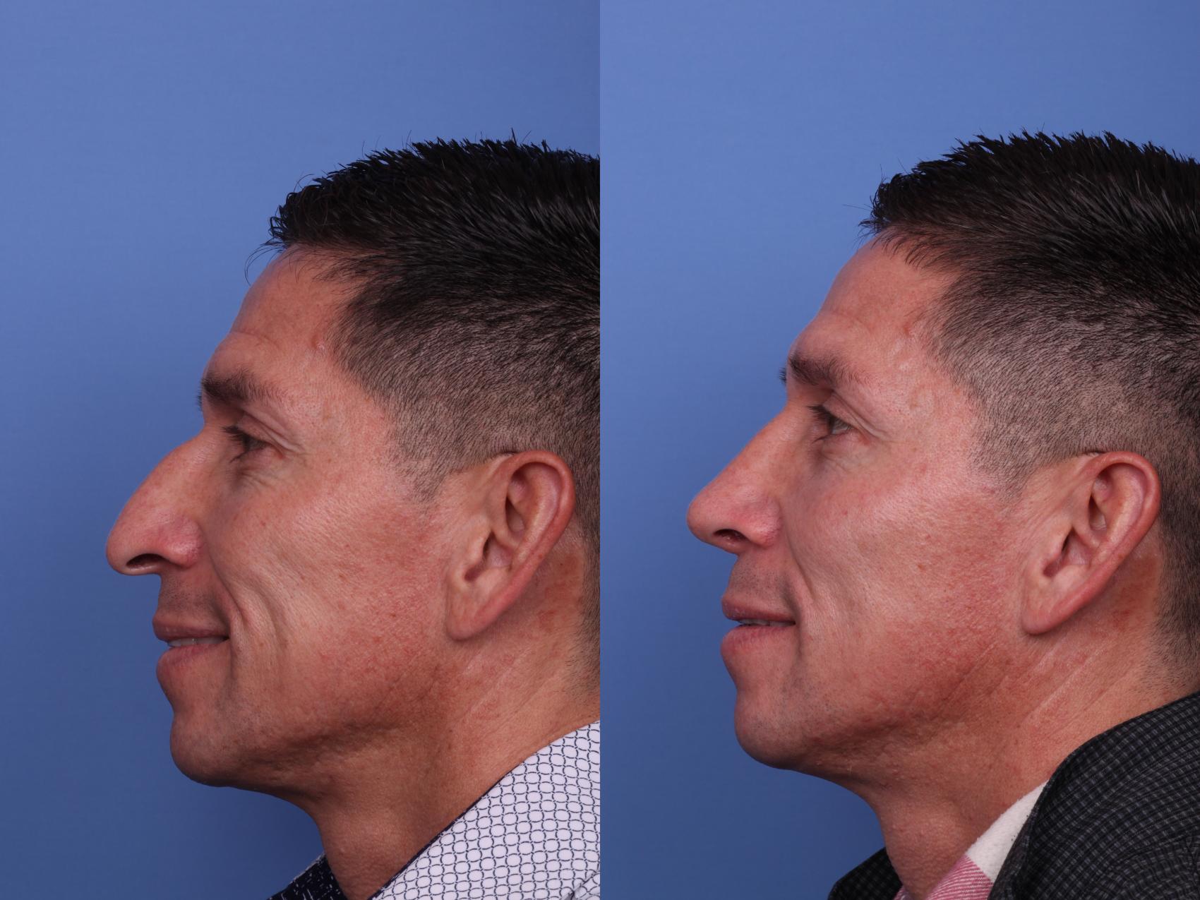 Before & After Ethnic Rhinoplasty Case 531 Left Smile View in Scottsdale, AZ