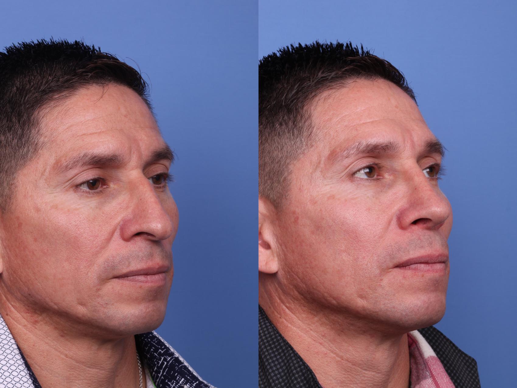 Before & After Ethnic Rhinoplasty Case 531 Right Oblique View in Scottsdale, AZ