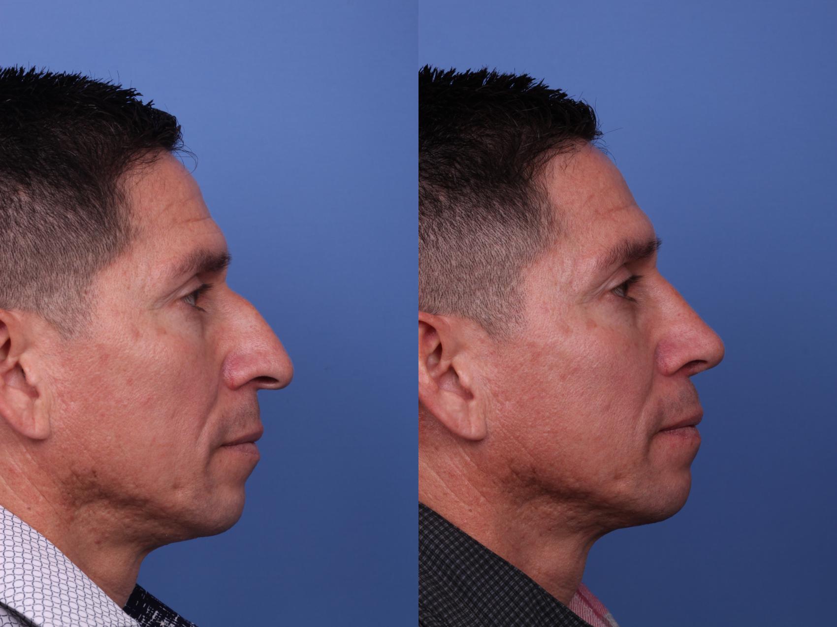 Before & After Ethnic Rhinoplasty Case 531 Right Side View in Scottsdale, AZ