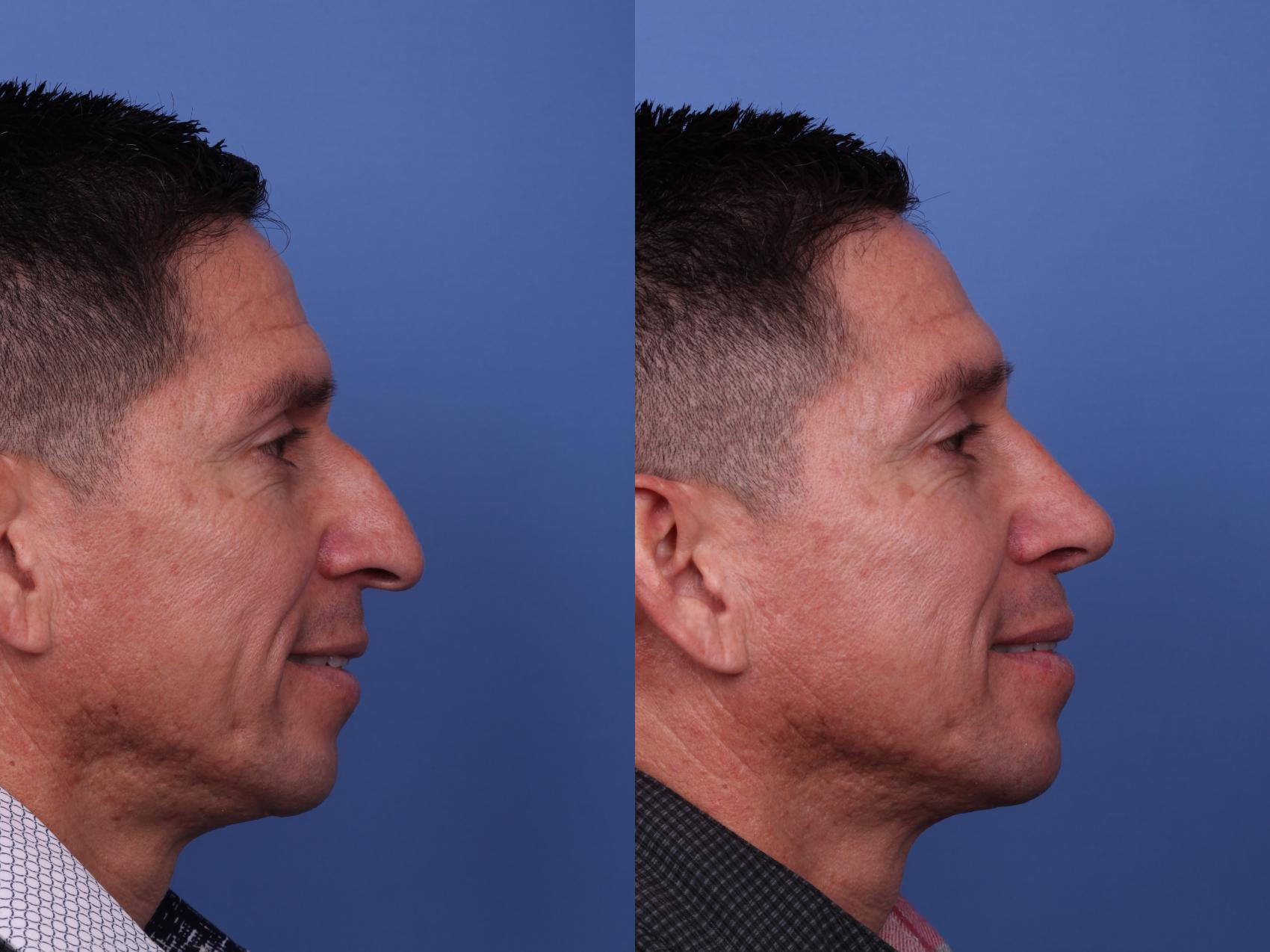 Before & After Ethnic Rhinoplasty Case 531 Right Smile View in Scottsdale, AZ