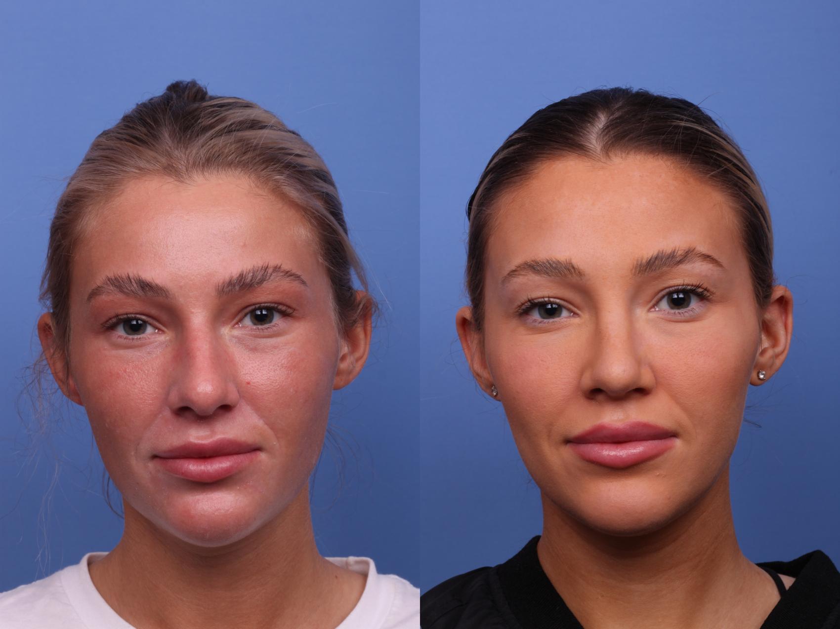 Before & After Rhinoplasty Case 534 Front View in Scottsdale, AZ