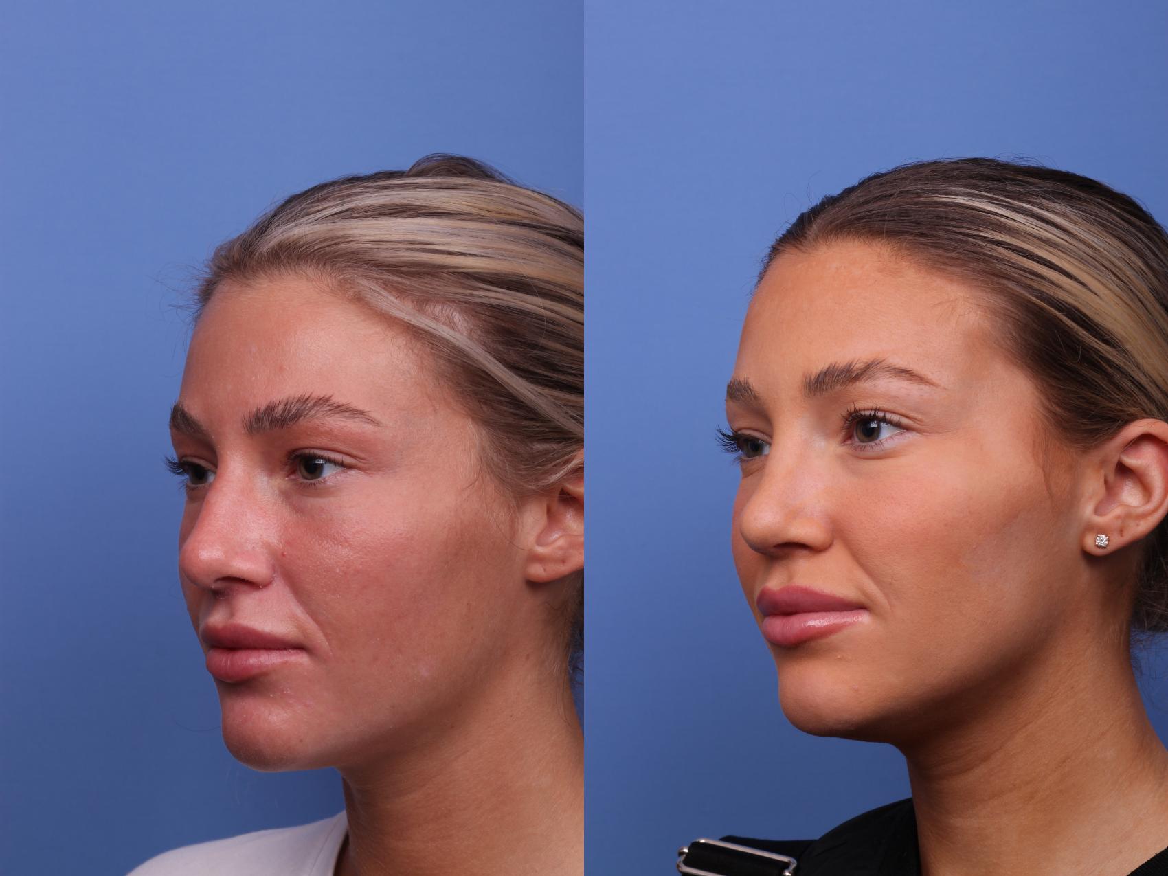 Before & After Rhinoplasty Case 534 Left Oblique View in Scottsdale, AZ