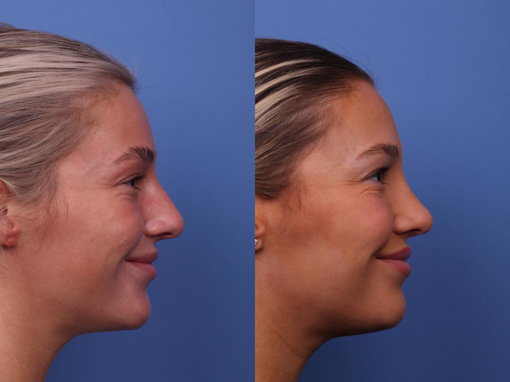 Before & After Rhinoplasty Case 534 Right Smile View in Scottsdale, AZ