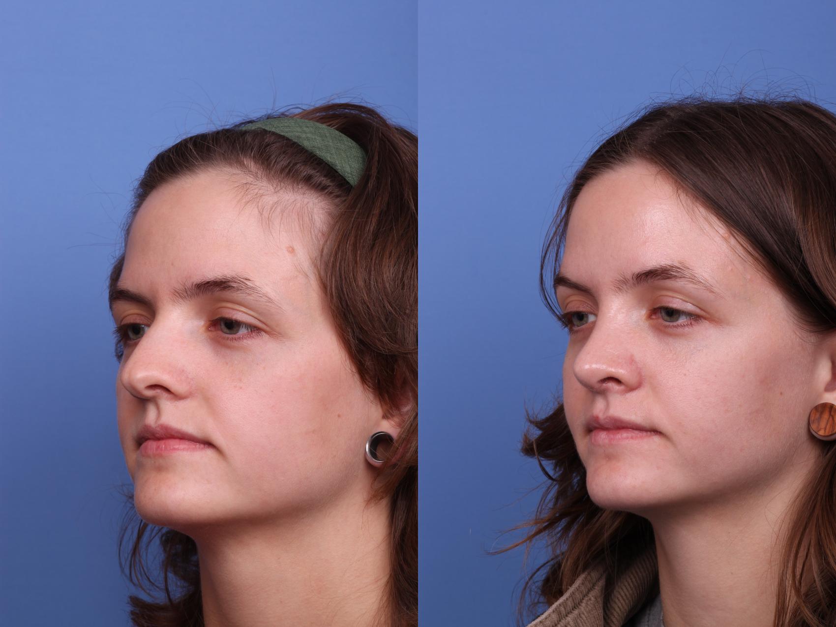 Before & After Rhinoplasty Case 535 Left Oblique View in Scottsdale, AZ