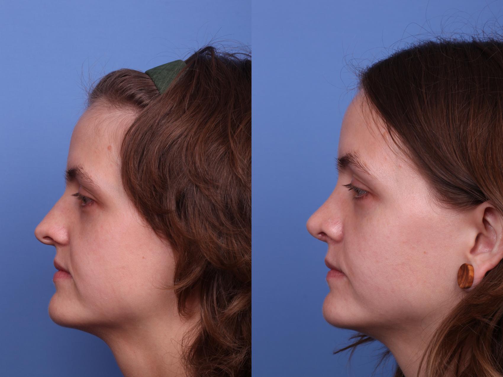 Before & After Rhinoplasty Case 535 Left Side View in Scottsdale, AZ