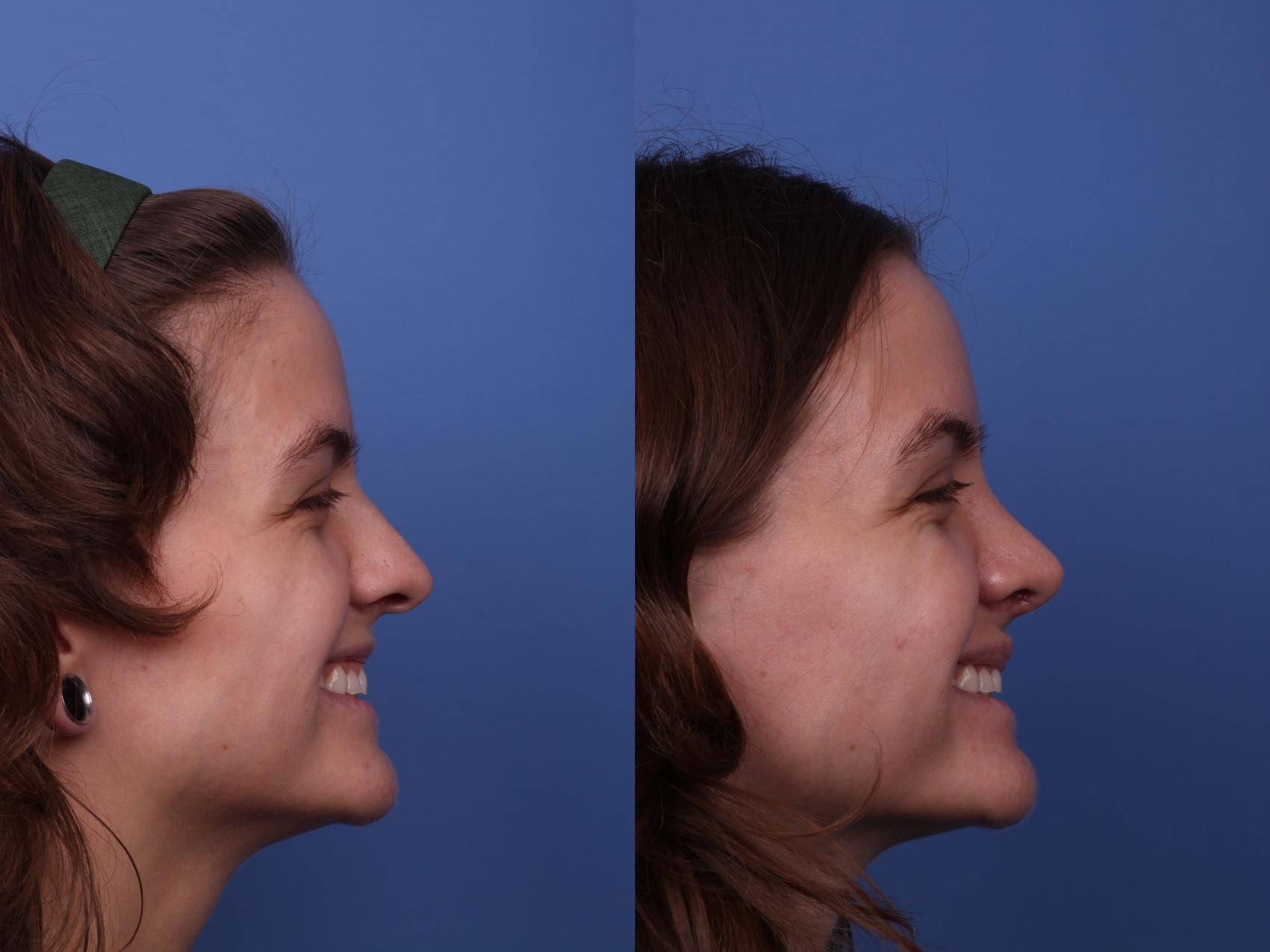 Before & After Rhinoplasty Case 535 Right Smile View in Scottsdale, AZ