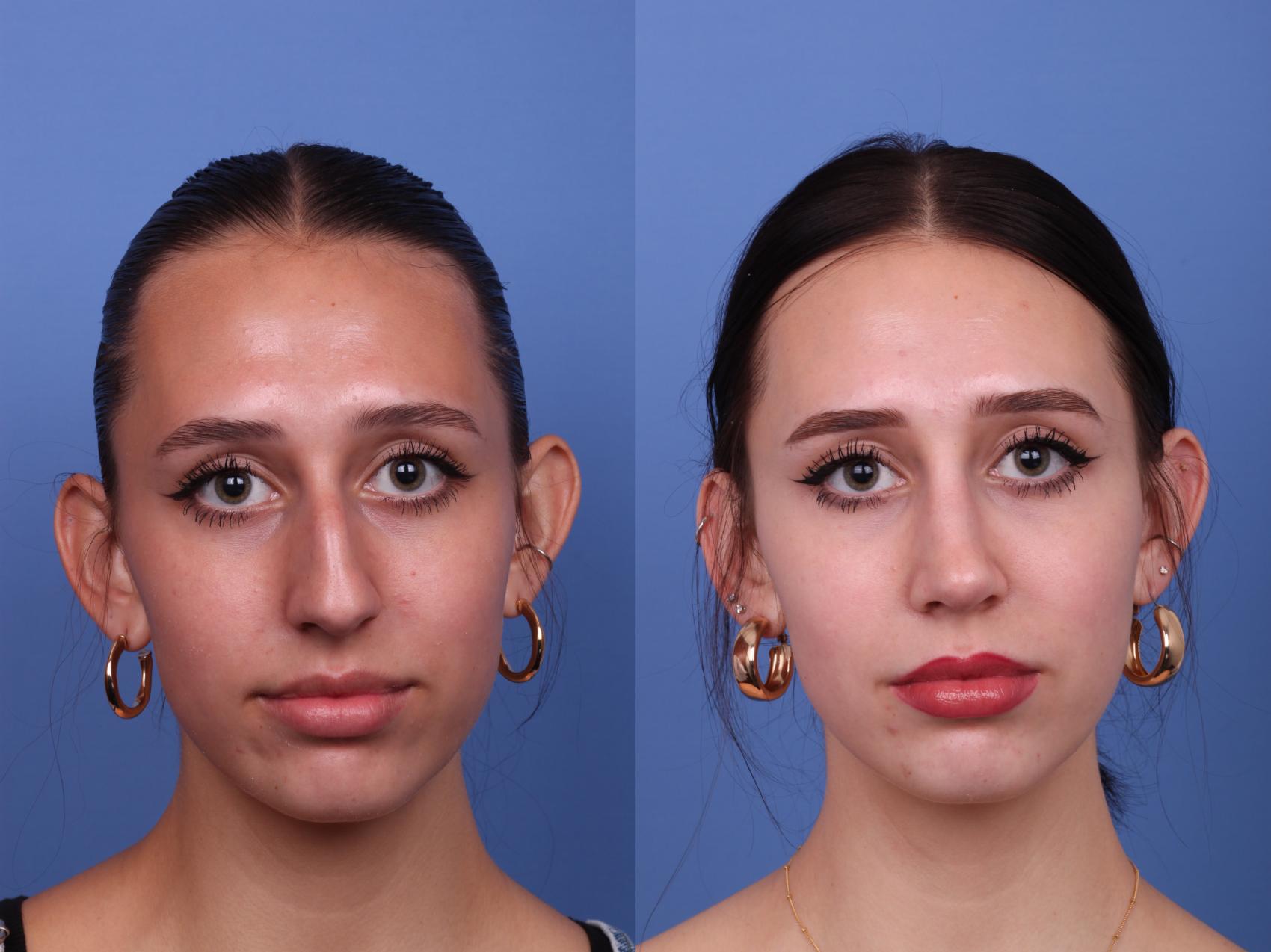 Before & After Rhinoplasty Case 540 Front View in Scottsdale, AZ