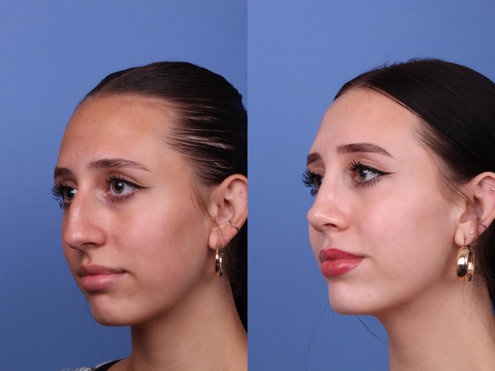 Before & After Rhinoplasty Case 540 Left Oblique View in Scottsdale, AZ