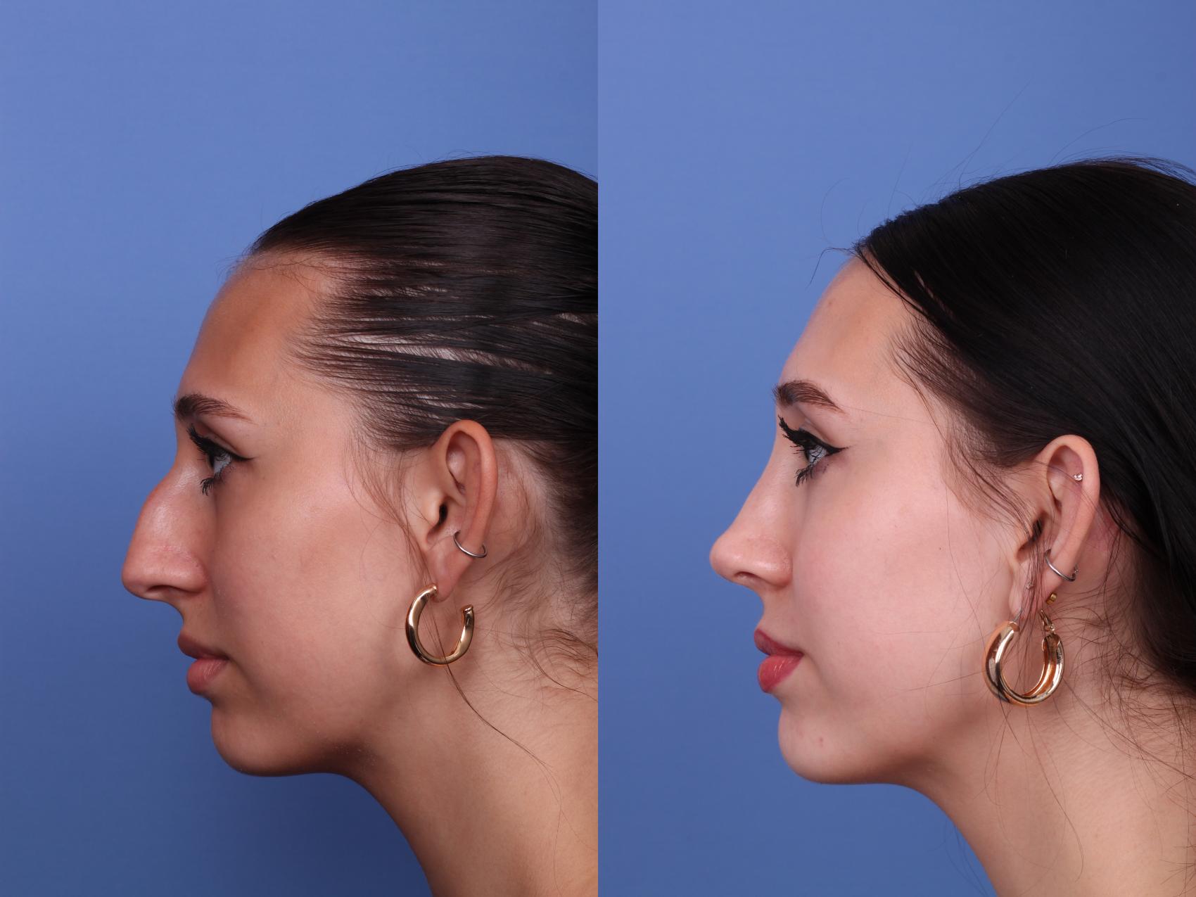 Before & After Rhinoplasty Case 540 Left Side View in Scottsdale, AZ