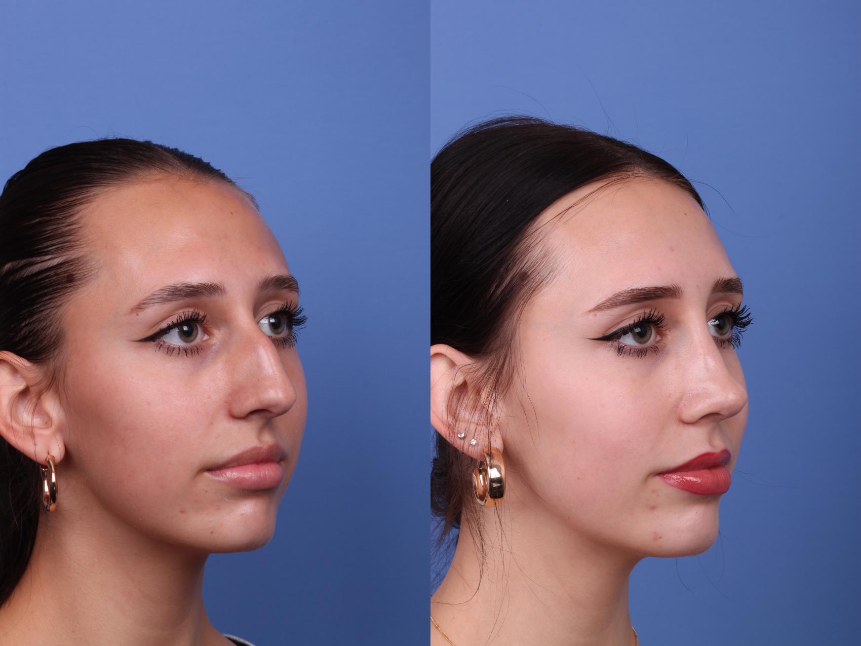 Before & After Rhinoplasty Case 540 Right Oblique View in Scottsdale, AZ