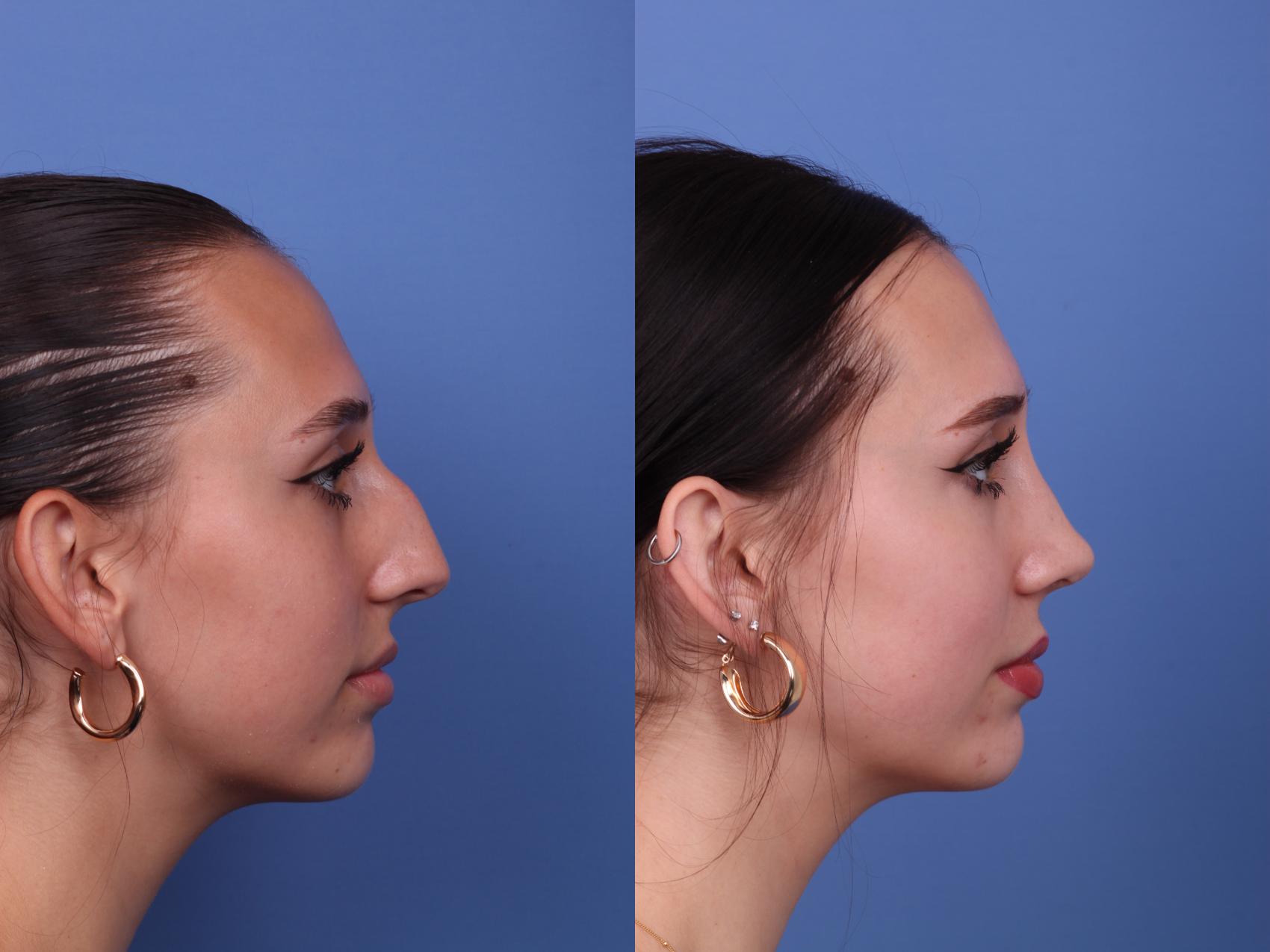 Before & After Rhinoplasty Case 540 Right Side View in Scottsdale, AZ